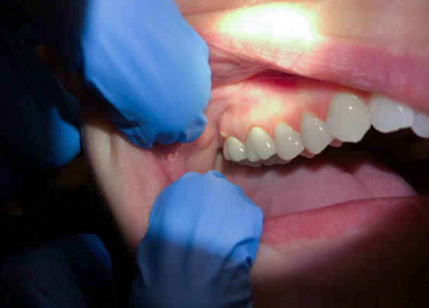 Best Cracked Tooth Emergency Dentist  in Pine Grove, PA